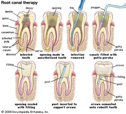 Root Canal